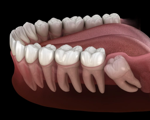 img-wisdom-tooth-extraction-How Do You Know If Wisdom Tooth Extraction Is Right for You